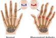 Therapy for Rheumatoid Arthritis in the Hand