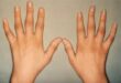 Hand Rheumatoid Arthritis Signs and Symptoms