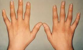 Hand Rheumatoid Arthritis Signs and Symptoms
