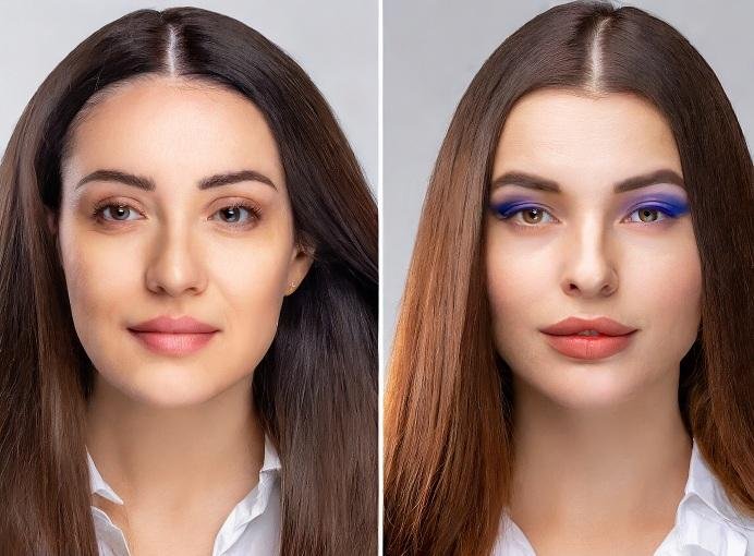 hair transplant before and after