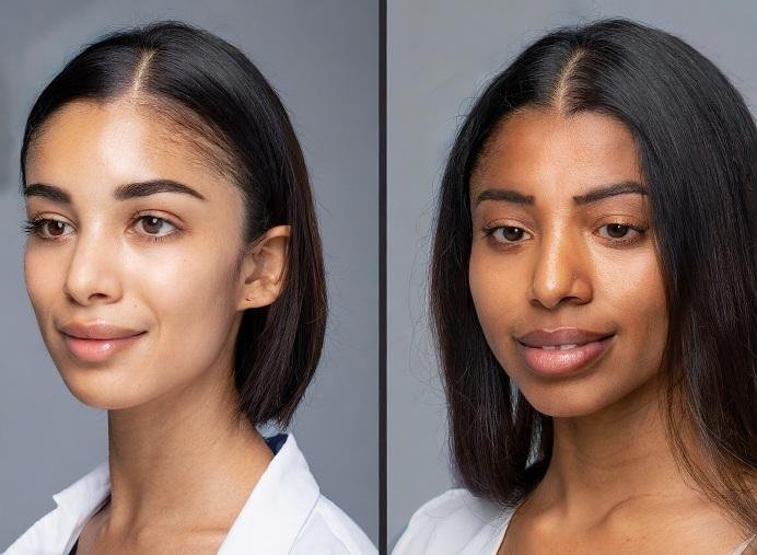 hair transplant before and after